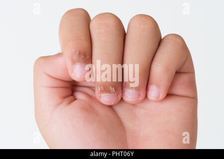 Nahaufnahme des Kindes Fingern, trockene Haut, Ekzem Dermatitis. Medizin und Gesundheit Konzept. Stockfoto