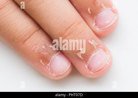 Nahaufnahme des Kindes Fingern, trockene Haut, Ekzem Dermatitis. Medizin und Gesundheit Konzept. Stockfoto