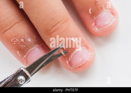 Nahaufnahme der Mutter mit einer Schere trockene Haut auf den Fingern des Kindes schneiden, Ekzeme Dermatitis. Medizin und Gesundheit Konzept. Stockfoto