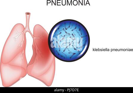 Vector Illustration der Pneumonie. Erreger - Klebsiella Stock Vektor