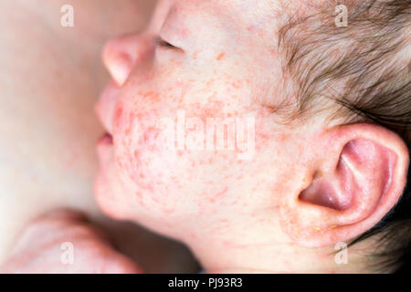 Neugeborenes Baby Junge Gesicht mit viele Pickel im Gesicht und Ohr Stockfoto