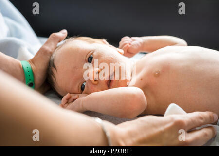 Neugeborenes Baby Junge Gesicht mit viele Pickel im Gesicht, unterstützt von seiner Mutter Stockfoto