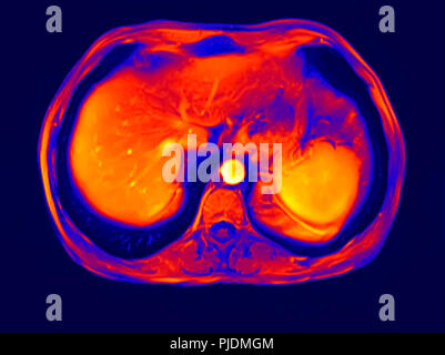 Querschnitt abdomen MRT-Untersuchung von 60 Jahre alten männlichen Patienten mit Nierensteinen Stockfoto