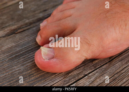 Beschädigte Zehennagel. Den Daumen auf das Bein des Mannes. Stockfoto