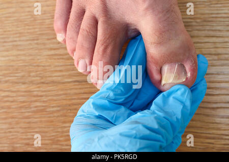 Eingewachsene Zehennagel zu Fuß. Arzt untersucht die Daumen. Stockfoto