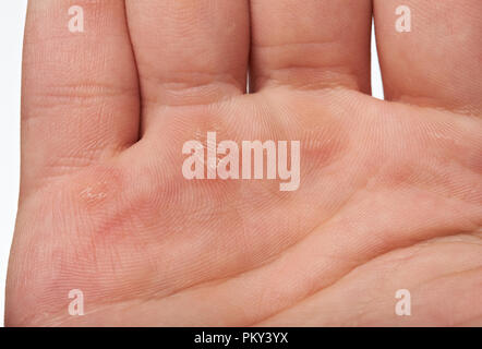 Verletzte palm Hand schließen oben mit Blister Stockfoto