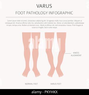 Fuß Verformung als medizinische Krankheit Infografik. Valgus und Varus defekt. Vector Illustration Stock Vektor