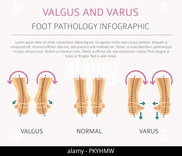 Fuß Verformung als medizinische Krankheit Infografik. Valgus und Varus defekt. Vector Illustration Stock Vektor