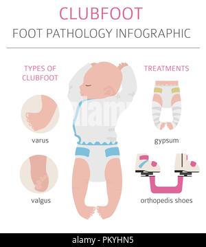 Fuß Verformung, medizinische Krankheit Infografik. Klumpfuß defekt. Vector Illustration Stock Vektor