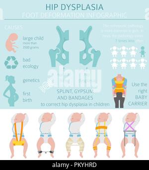 Fuß Verformung Arten, medizinische Krankheit Infografik. Hüftdysplasie bei Kindern. Vector Illustration Stock Vektor