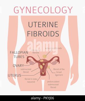 Uterusmyome. Ginecological medizinische Krankheit bei Frauen Infografik. Vector Illustration Stock Vektor