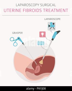 Uterusmyome. Ginecological medizinische Krankheit bei Frauen Infografik. Vector Illustration Stock Vektor