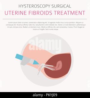 Uterusmyome. Ginecological medizinische Krankheit bei Frauen Infografik. Vector Illustration Stock Vektor