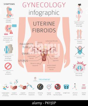 Uterusmyome. Ginecological medizinische Krankheit bei Frauen Infografik. Vector Illustration Stock Vektor