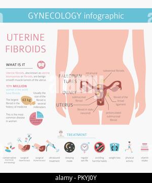 Uterusmyome. Ginecological medizinische Krankheit bei Frauen Infografik. Vector Illustration Stock Vektor