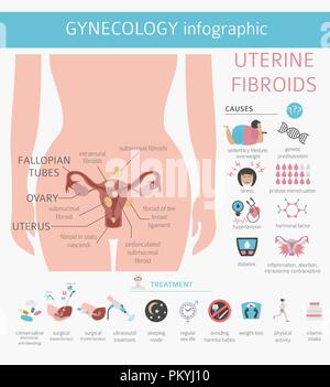 Uterusmyome. Ginecological medizinische Krankheit bei Frauen Infografik. Vector Illustration Stock Vektor