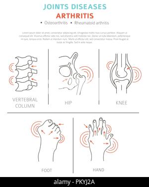 Gelenke Krankheiten. Arthritis Symptome, Behandlung Icon Set. Medizinische Infografik Design. Vector Illustration Stock Vektor