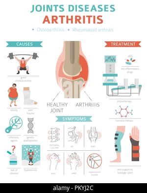 Gelenke Krankheiten. Arthritis Symptome, Behandlung Icon Set. Medizinische Infografik Design. Vector Illustration Stock Vektor