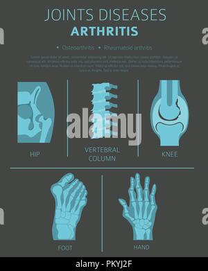 Gelenke Krankheiten. Arthritis Symptome, Behandlung Icon Set. Medizinische Infografik Design. Vector Illustration Stock Vektor