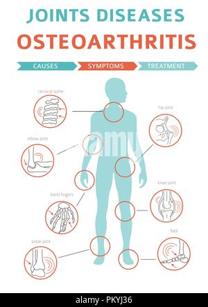 Gelenke Krankheiten. Arthritis, Arthrose Symptome, Behandlung Icon Set. Medizinische Infografik Design. Vector Illustration Stock Vektor