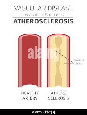 Gefäßerkrankungen. Arteriosklerose Symptome, Behandlung Icon Set. Medizinische Infografik Design. Vector Illustration Stock Vektor