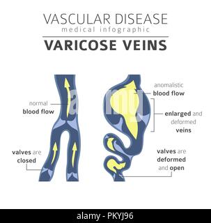 Gefäßerkrankungen. Krampfadern Symptome, Behandlung Icon Set. Medizinische Infografik Design. Vector Illustration Stock Vektor