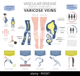 Gefäßerkrankungen. Krampfadern Symptome, Behandlung Icon Set. Medizinische Infografik Design. Vector Illustration Stock Vektor