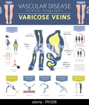 Gefäßerkrankungen. Krampfadern Symptome, Behandlung Icon Set. Medizinische Infografik Design. Vector Illustration Stock Vektor