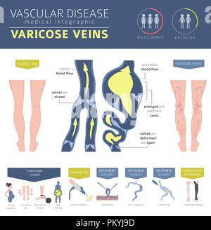 Gefäßerkrankungen. Krampfadern Symptome, Behandlung Icon Set. Medizinische Infografik Design. Vector Illustration Stock Vektor