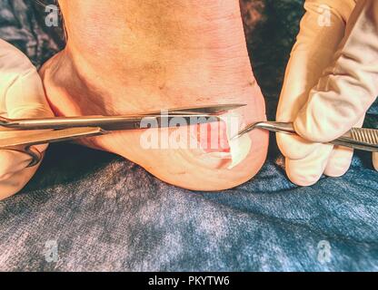 Krankenschwester Reinigung der toten Haut am Bein des Patienten mit Spike Schere, blau sterile Hintergrund. Tiefe Kratzer auf der Haut mit Prellungen und nassen Titel Stockfoto