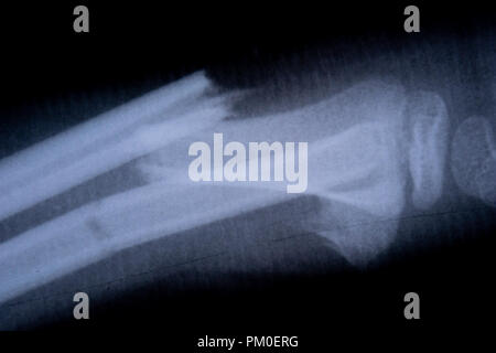 X-ray film Skelett menschlichen Arm. Gesundheit Medizin Anatomie Körper Konzept Stockfoto