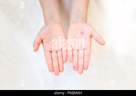 Die Hand eines Kindes mit Windpocken in der Hand der Mutter. Blasen an der Hand von Windpocken. Stockfoto