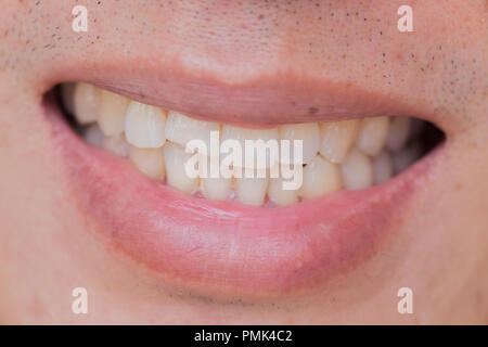 Hässlich Lächeln zahnmedizinisches Problem. Verletzungen der Zähne oder Zähne bei männlichen Brechen. Trauma und Nervenschäden der verletzten Zahn, bleibenden Zähne Verletzungen. Stockfoto