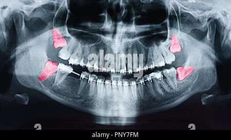 Wachsende Weisheitszähne Schmerzen auf Röntgenbild Stockfoto