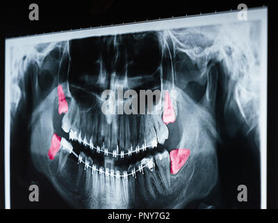 Wachsende Weisheitszähne Schmerzen auf Röntgenbild Stockfoto