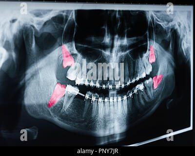 Wachsende Weisheitszähne Schmerzen auf Röntgenbild Stockfoto