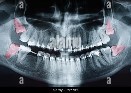 Wachsende Weisheitszähne Schmerzen auf Röntgenbild Stockfoto