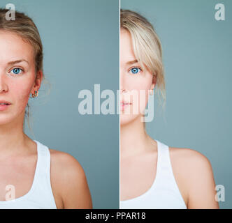 Gesunde und ungesunde Haut Konzept. Junge Modell Frau mit Haut Problem. Gesichtspflege, Hautpflege, Medizin und Kosmetik Konzept Stockfoto