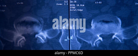 Medizinische Klinik x-ray Hüfte Wirbelsäule Becken MRI Traumatologie scannen. Stockfoto