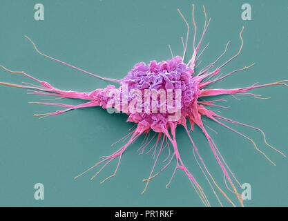 Dendritische Zelle. Farbige Scanning Electron Micrograph (SEM) von einer schützenden Zelle des menschlichen Immunsystems als dendritische Zelle bekannt. Die lange Projektionen auf der Oberfläche der Zelle gesehen sind 'Füße' zu helfen, es zu verschieben. Diese Zellen Prozess fremde Antigene, die dann wie ein Alarmsignal handeln, Alarmierung andere Immunzellen des Körpers auf die Infektion. Dendritische Zellen in der oberen Schicht der Haut (Epidermis) werden als histiocytes oder Langerhans Zellen bekannt. Im zentralen Nervensystem werden Sie als mikroglia bekannt, und in der Leber als Kupffer Zellen. Vergrößerung: x3000 bei 10 cm Breite gedruckt. Stockfoto