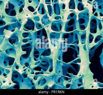 Knochengewebe. Farbige Scanning Electron Micrograph (SEM) der menschlichen Spongiosa (schwammig) Knochen. Das Knochengewebe kann entweder kortikalen werden (Kompakt) oder Spongiosa. Kortikalen Knochen macht in der Regel das Äußere der Knochen, während Spongiosa im Innenraum gefunden wird. Spongiosa wird durch eine wabenförmige Anordnung gekennzeichnet, bestehend aus einem Netzwerk von trabekeln (stabförmige Gewebe). Diese Strukturen bieten Support und Festigkeit der Knochen. Die Räume innerhalb dieses Gewebe enthalten, Knochenmark (nicht gesehen), ein Blut bilden Substanz. Vergrößerung: 13 x 10 cm Breite gedruckt. Stockfoto