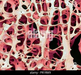 Knochengewebe. Farbige Scanning Electron Micrograph (SEM) der menschlichen Spongiosa (schwammig) Knochen. Das Knochengewebe kann entweder kortikalen werden (Kompakt) oder Spongiosa. Kortikalen Knochen macht in der Regel das Äußere der Knochen, während Spongiosa im Innenraum gefunden wird. Spongiosa wird durch eine wabenförmige Anordnung gekennzeichnet, bestehend aus einem Netzwerk von trabekeln (stabförmige Gewebe). Diese Strukturen bieten Support und Festigkeit der Knochen. Die Räume innerhalb dieses Gewebe enthalten, Knochenmark (nicht gesehen), ein Blut bilden Substanz. Vergrößerung: 13 x 10 cm Breite gedruckt. Stockfoto