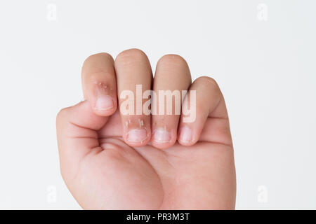 Nahaufnahme des Kindes Fingern, trockene Haut, Ekzem Dermatitis. Medizin und Gesundheit Konzept. Stockfoto