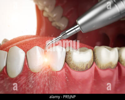 Professionelle Zahnreinigung. Ultraschall Zähne Reinigen der Maschine Zahnstein von menschlichen Zähnen zu löschen. 3D-Darstellung Stockfoto