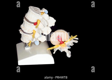 Seitenansicht Modell Wirbelsäule Wirbelsäule von fünf Wirbel auf schwarzen Hintergrund mit Platz für Text Stockfoto