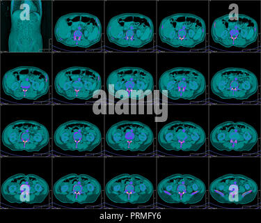 Die Brust in der Computertomographie, CT-Bild Stockfoto