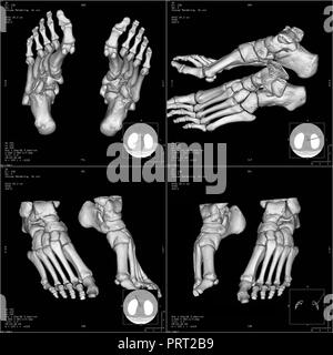 Knochen der Fuß in dreidimensionale CT- Stockfoto