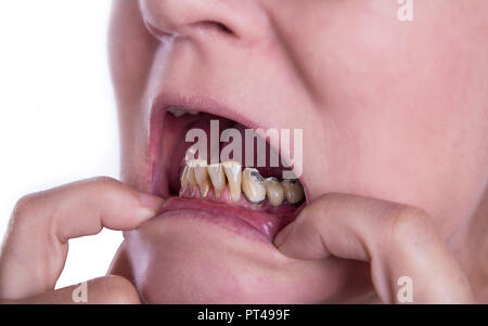 Frau mit schlechten Zähnen und Zahnstein vom Rauchen und alten Kronen Stockfoto