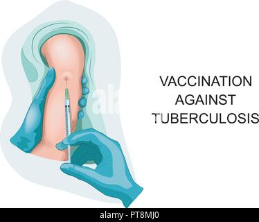 Vector Illustration von Kind Impfung gegen Tuberkulose. Stock Vektor