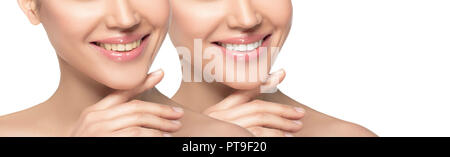 Frau Lächeln vor und nach dem Bleichen von Zähnen isoliert auf weißem Stockfoto
